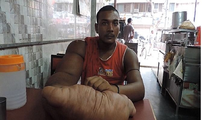 Indian man with huge 20kg arm is forced to flee his home.