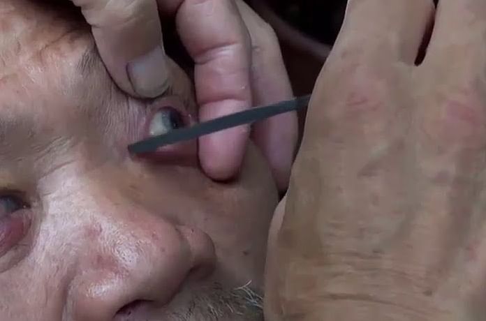 Guy use knife for eye cleaning in china