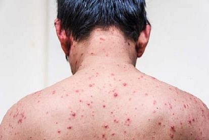 Chickenpox: दक्षिणी राज्यों में चिकनपॉक्स-खसरा के बढ़ते मामलों को लेकर अलर्ट, कैसे करें इन रोगों से बचाव Kerala witnessing surge in chickenpox cases know symptoms and prevention tips in hindi