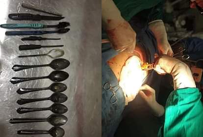 तस्वीरें: डॉक्टर भी हैरान, मरीज के पेट से निकले चम्मच, टुथब्रश, चाकू, रॉड और पेचकस Doctors found toothbrush iron rod spoon and Screwdriver in patient stomach