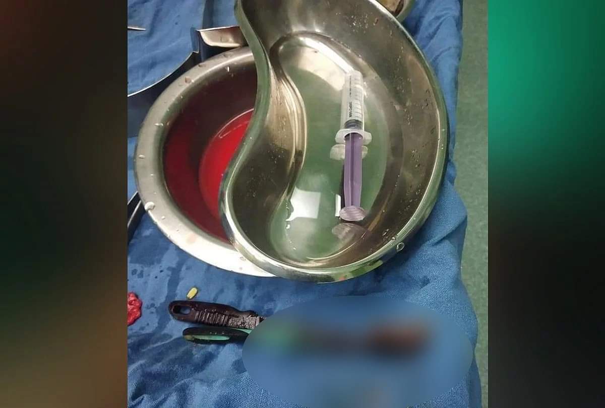 तस्वीरें: डॉक्टर भी हैरान, मरीज के पेट से निकले चम्मच, टुथब्रश, चाकू, रॉड और पेचकस Doctors found toothbrush iron rod spoon and Screwdriver in patient stomach