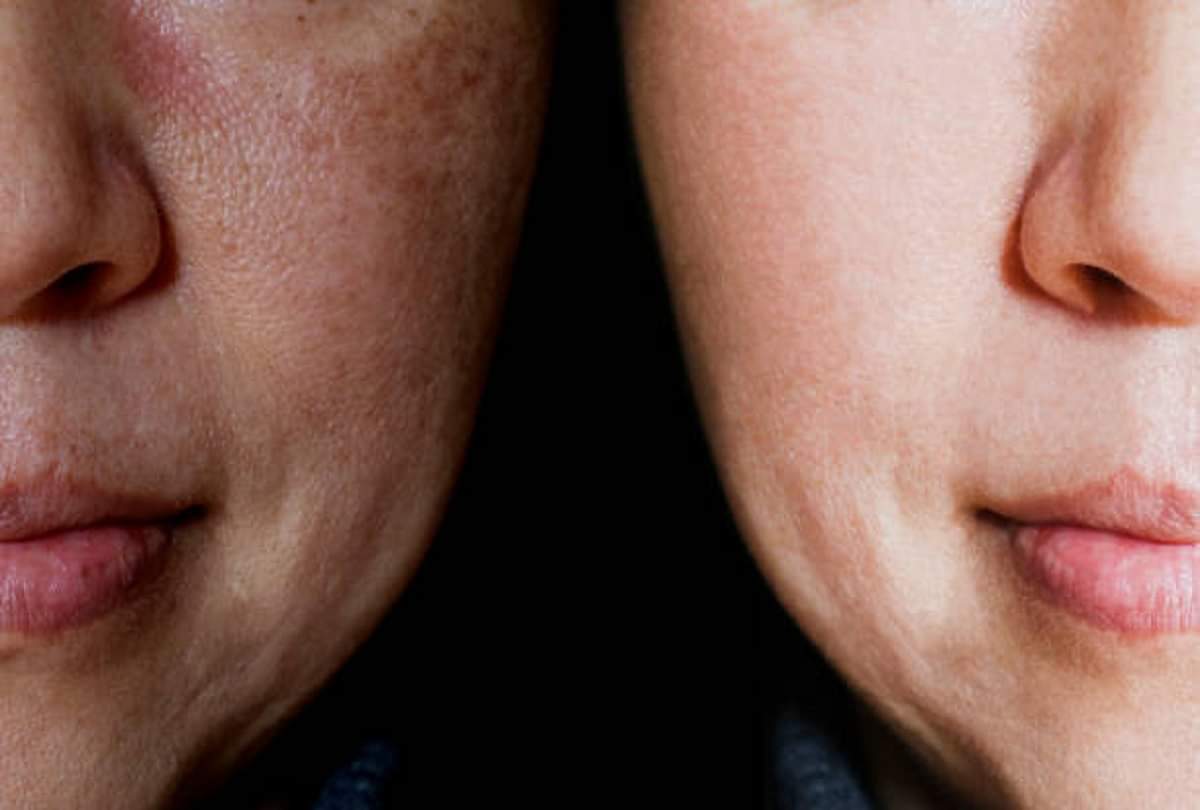 Wrinkle Free Skin: त्वचा पर आ रहीं झुर्रियों को भगाना है तो पानी में ये चीज मिलाकर लगाएं, दिखेगा असर alum water to reduce wrinkles and get rid of loose skin