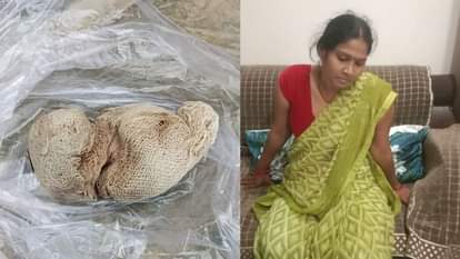 UP: ऑपरेशन के बाद डॉक्टर ने महिला के पेट में छोड़ दिया पट्टी का गोला, तकलीफ बढ़ने पर पांच माह बाद हुआ खुलासा Barabanki: After the operation, the doctor left a ball of bandage in the woman's stomach.