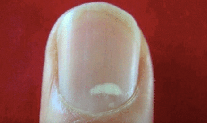 The real reason behind the white marks on your nails