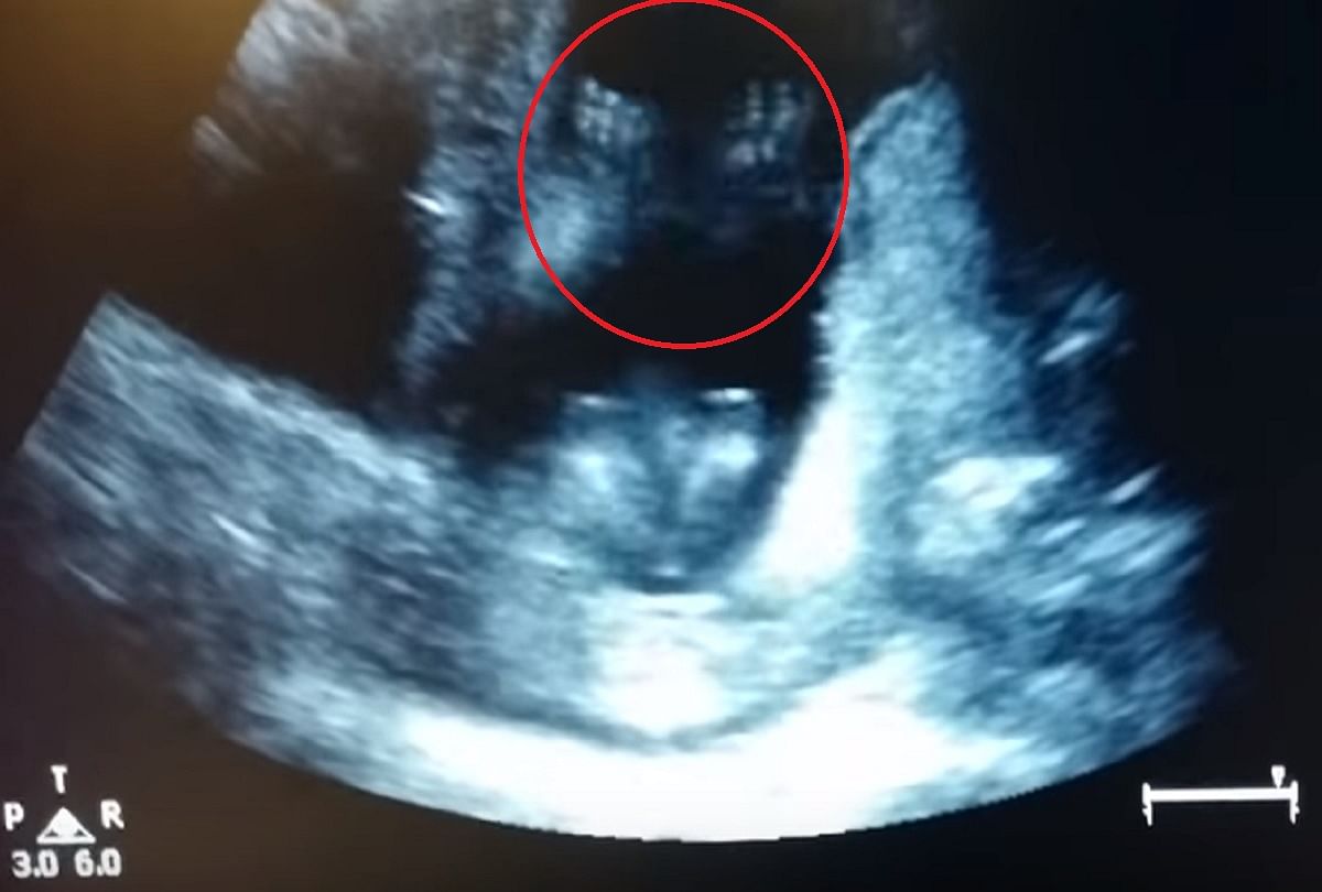 a 14 week baby clapping in womb to listening a poetry