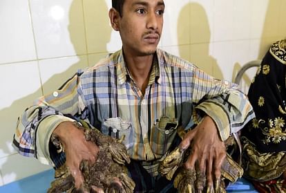 bangladesh tree man abul bajandar will need more surgery to remove bark like growths