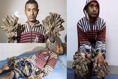 bangladesh tree man abul bajandar will need more surgery to remove bark like growths