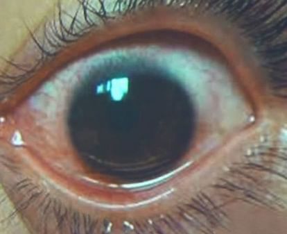 woman used phone on max screen brightness suffers 500 holes in eyes cornea