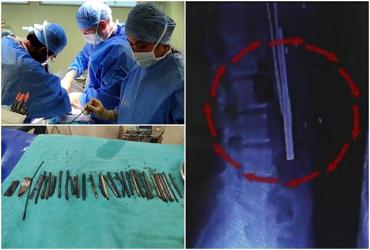 more than 33 items including pens saw needle inside the patient stomach