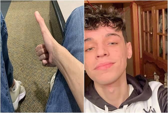 massachusetts student is viral on tik tok student have five inch long thumb