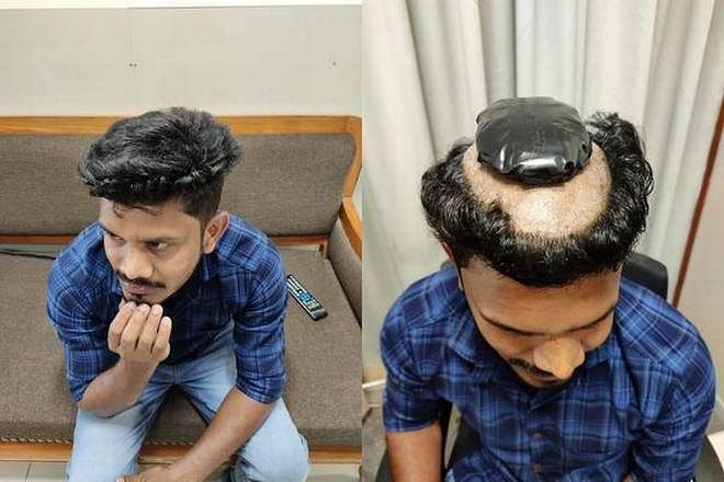 man caught at kochi airport tries smuggling 1kg gold under his wig