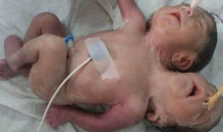 mp woman gives birth to boy with 2 heads 3 hands and one heart
