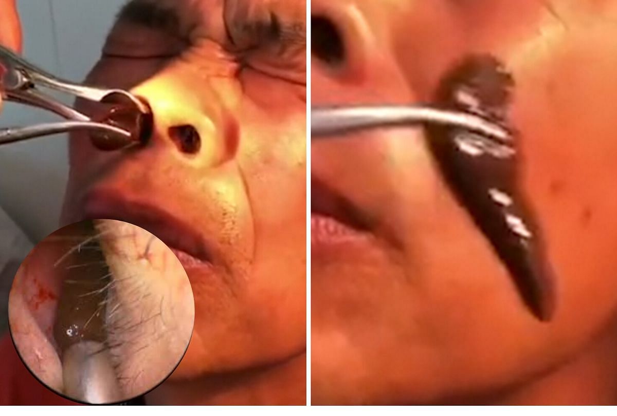 Doctors Find 2 Leeches Chinese Man Inside His Nostril And Throat