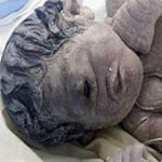 baby with one eye