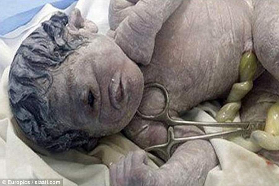baby without a nose and one eye took birth
