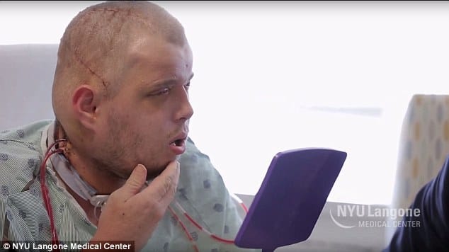 first ever full facial transplant sucessful