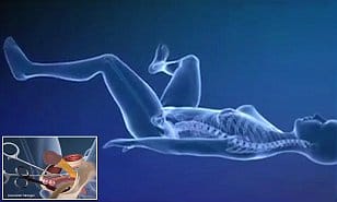 sex change surgery full process