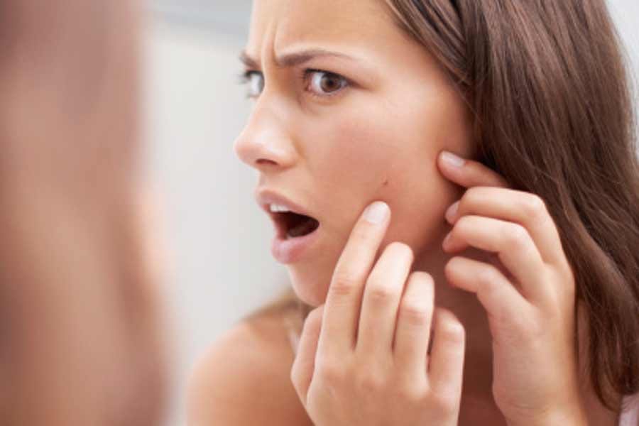 home remedies for pimples