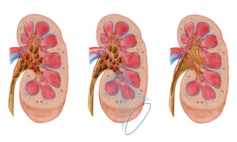 vitamin d causes kidney problems