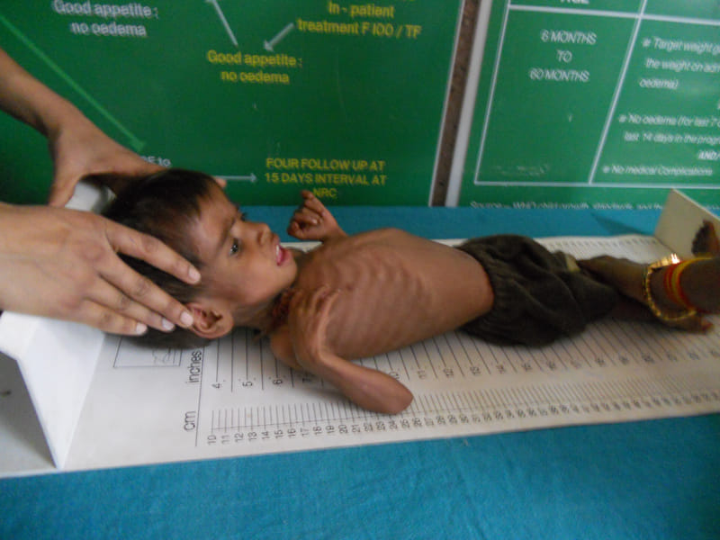 Malnutrition becoming strong day by day