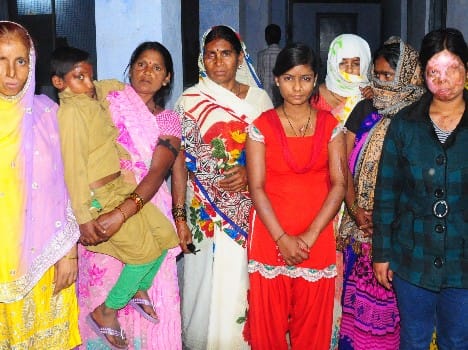 story of acid attack victim of up