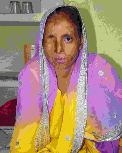 story of acid attack victim of up