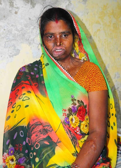 story of acid attack victim of up