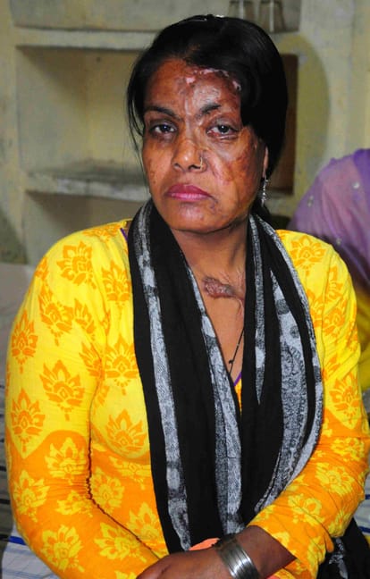 story of acid attack victim of up