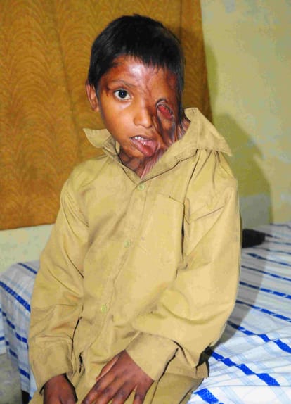 story of acid attack victim of up