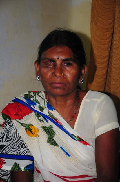 story of acid attack victim of up