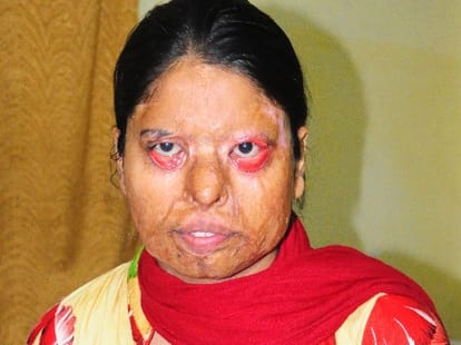 story of acid attack victim of up