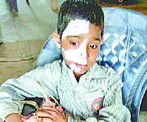 Scorched by pouring hot food