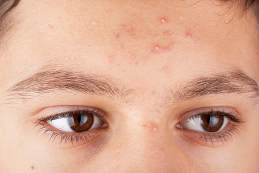 reason for men's acne know treatment and prevention