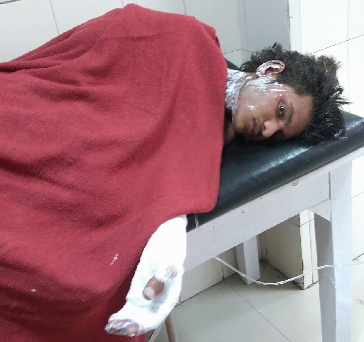 student leader caught fire, serious burn.