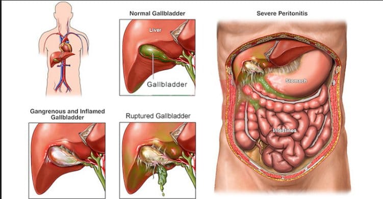 pgi reserch, dbt reserch, gall bladder stone, cancer, gall bladder, health update, chandigarh