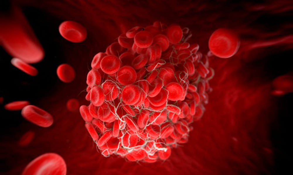 Blood Clot Can Be Dangerous