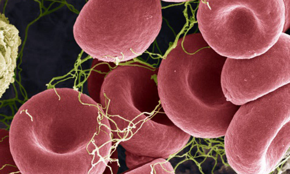 Blood Clot Can Be Dangerous