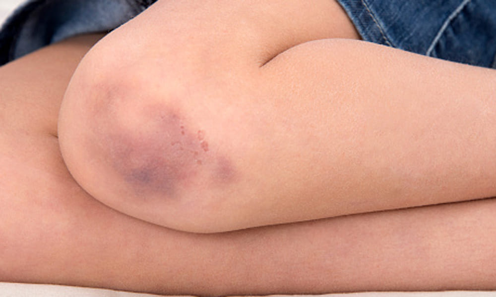 Blood Clot Can Be Dangerous