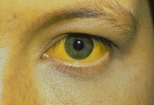 death with jaundice in igmc shimla