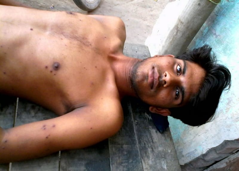Chicken Pox, who suffered 10 people