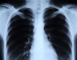 x-ray machine radiation proves to be hazardous for health