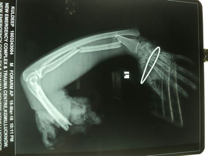 Big surgery by KGMU doctors.