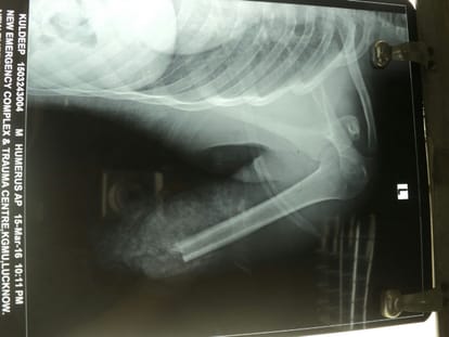 Big surgery by KGMU doctors.