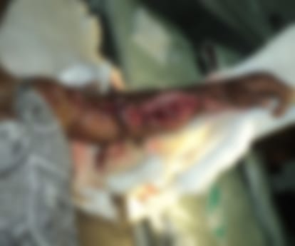 Big surgery by KGMU doctors.