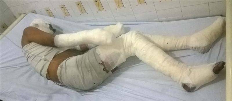 Cylinder fire , five people in the house scorched