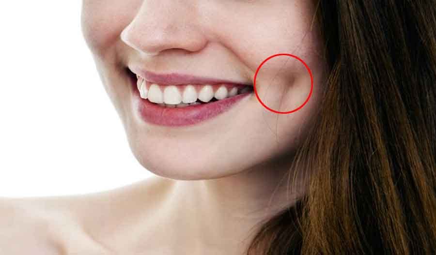 why do some people have dimples