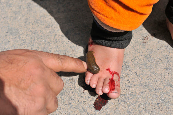 In this part of the country is treated with leech