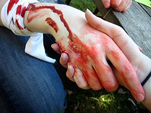 girl beaten by her friend shows symptoms of rabbies