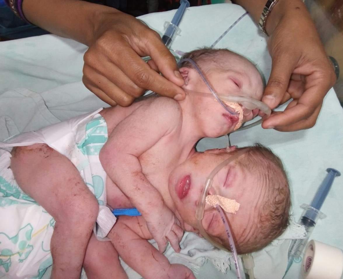 Two-headed baby born in dehradun.