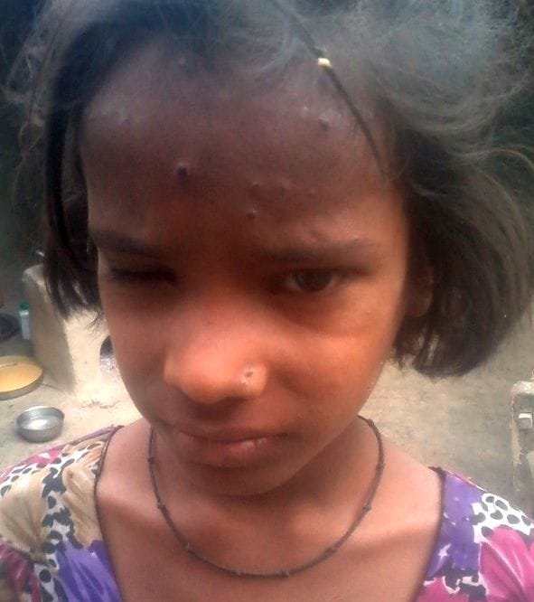 Many villages spread measles, 70 ill